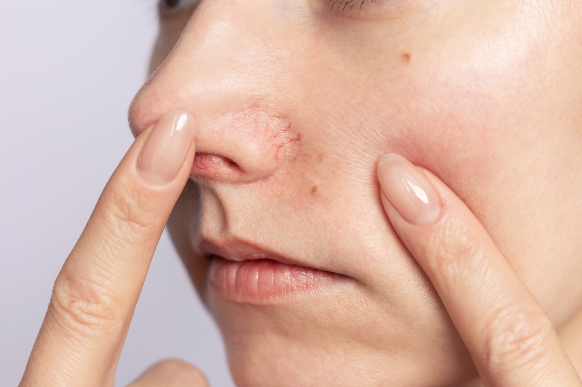 Cera naczynkowa – pielęgnacja skóry wrażliwej i skłonnej do zaczerwienień